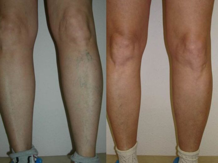ноге пре и после ласерског третмана проширених вена