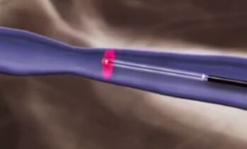 Термички третмани